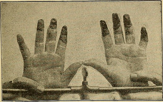 A very old photo of two hands with gangrene in the fingertips.